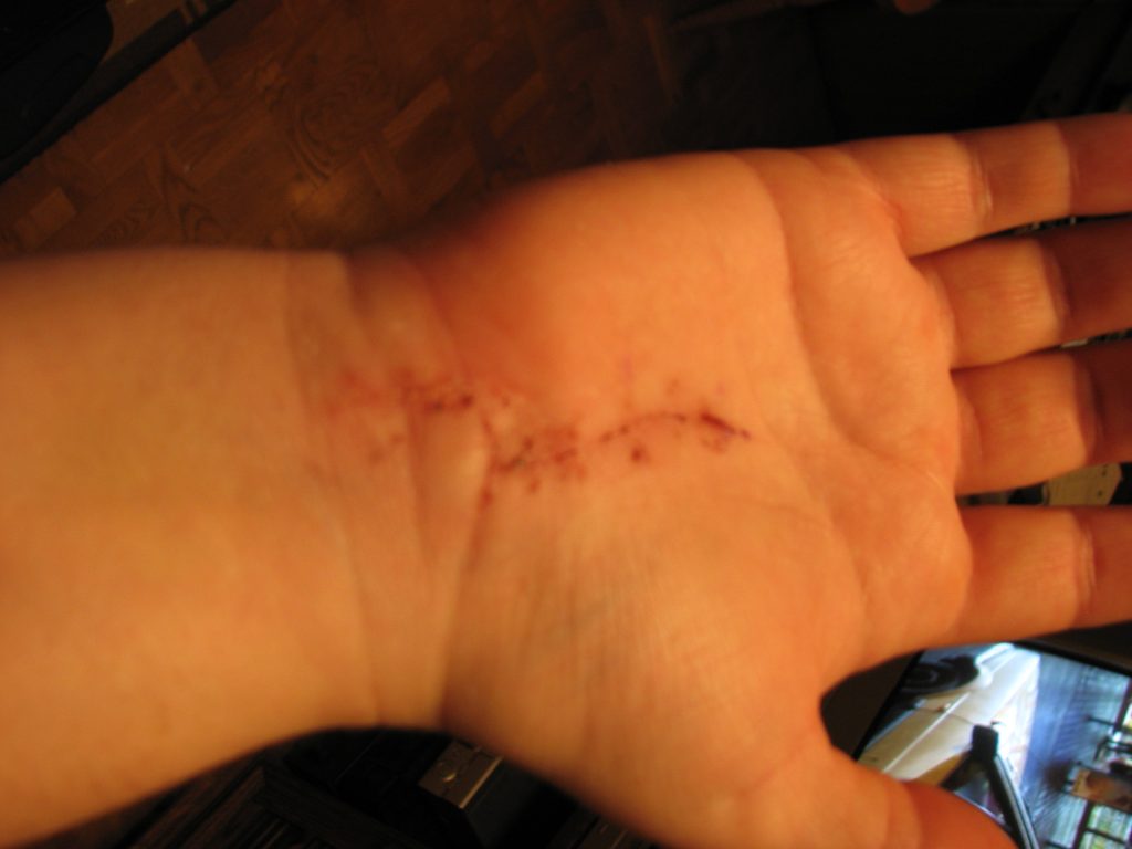 Stygn efter karpaltunneloperation.
